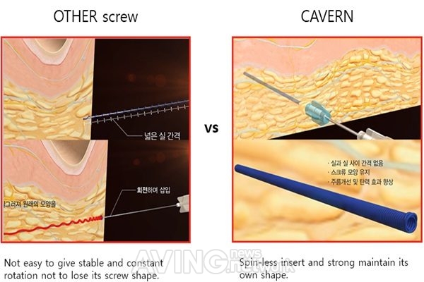 [미리보는 KIMES 2018] 네오닥터, 윤곽 개선 효과에 탁월한 제품 Cavern(캐번) 선봴 예정